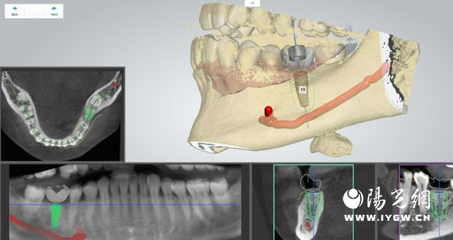 西安交大口腔医院专家解析数字化种植bob半岛体育牙：口腔医疗的新篇章(图3)