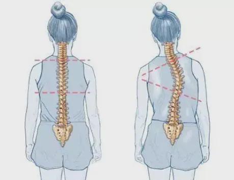 家长BOB半岛们请注意 牙齿咬合不正当心脊柱侧弯！